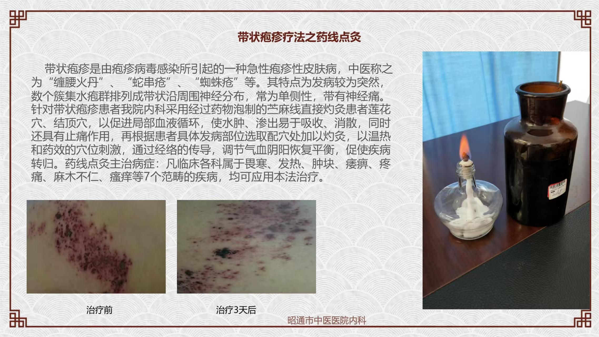 带状疱疹疗法.jpg